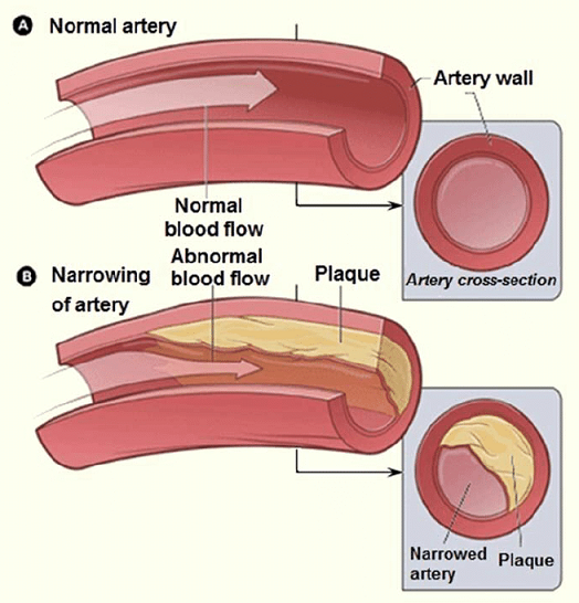 Part of the body / function involved in Angiospasm and Arteriosclerosis