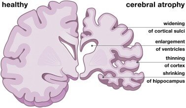 Image shows the difference between a healthy brain and  brain going through atrophy