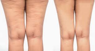 Effects of Cellulite on the fat of the legs.