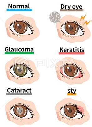 Picture of six eyes showing a normal eye and five symptoms which occur with Eye Diseases - Dry eyes, glaucoma, keratitis, cataract, sty, 
