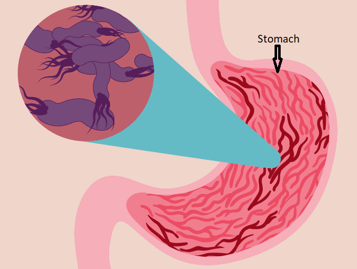 Illustration of the stomach showing a magnified picture of possible worms / bacteria causing Gastritis