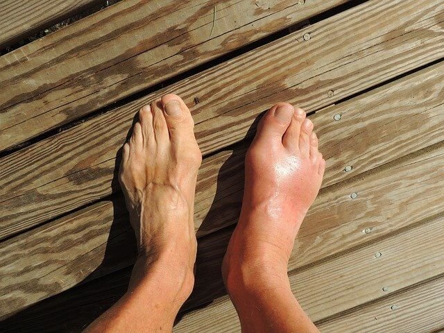 Picture of two feet with the left one suffering from Gout - Uric Acid