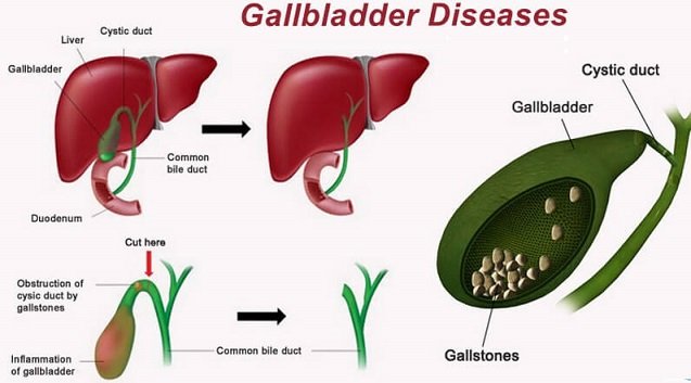 effect and symptoms which occur with Liver and Gall Bladder Disease