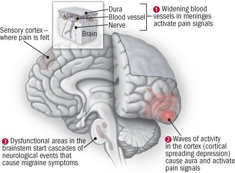 effect and symptoms which occur with Migraines