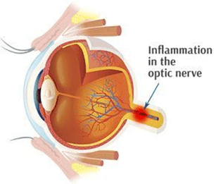 Illustration of the eye the optic nerve that is inflamed causing the neuritis