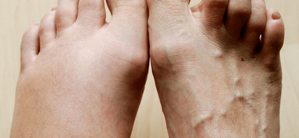 Close up of two feet showing difference between one with odema and one without