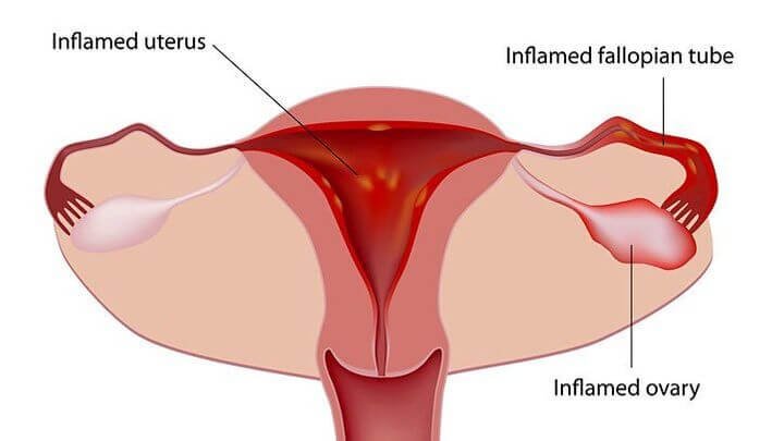 Illustration showing possible inflammation in the fallopian, uterus, and ovary which may be causing period problems 