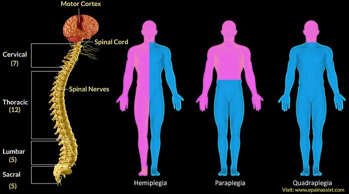 Shows the spinal cord and the different types of issues that can occur when signaling of nerves is cut at different points - hemiplegia, paraplegia and Quadriplegia