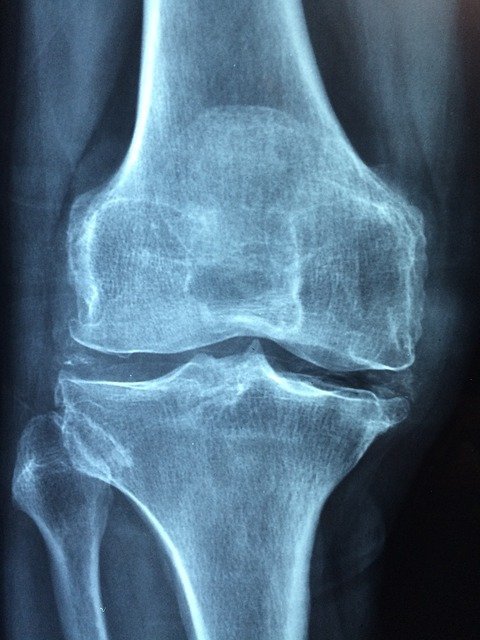 X-ray of a knee with Rheumatoid Arthritis