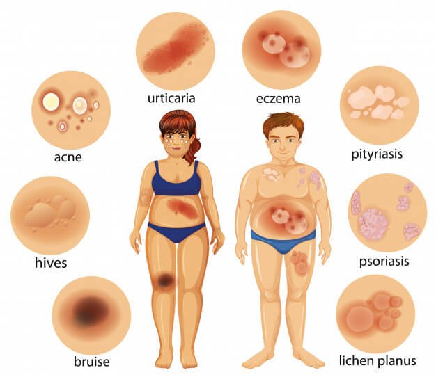 Picture of a man and women and the different types of Skin Diseases they may have - urticaria, eczema, pityriasis, acne, hives, bruise, lichen planus, psoriasis