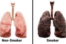 Comparison illustrations of the healthy lungs of a non-smoker and the unhealthy lungs of a smoker. Shows the impact of long term smoking.
