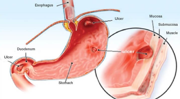 Shows an illustration of the stomach and how an ulcer develops