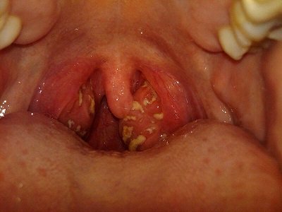 Photo of the tonsils with white dots all over