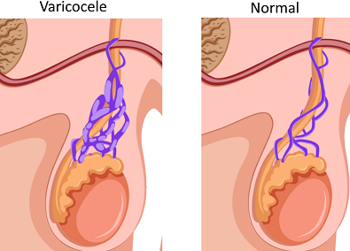 Cross section of the testicles showing the difference in structure when someone suffers from varicocele.