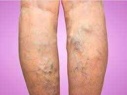 Shows to effected legs with Varicose Veins bulging out from the surface