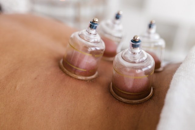 Four hijama cups applied on the lower back
