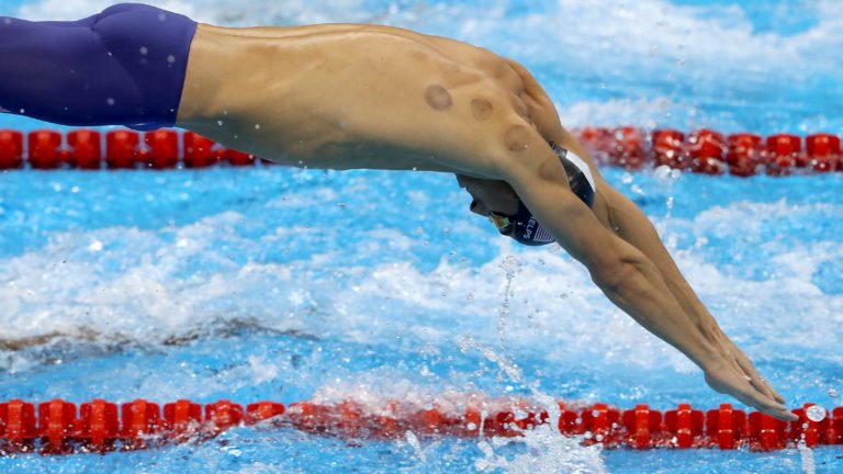 Swimming - Olympics: Day 2 Pictures of skin reaction after cupping and what it means