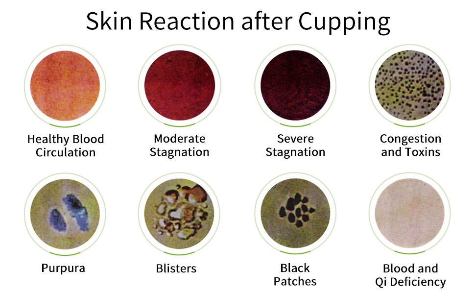 Pictures of skin reaction after cupping and what it means